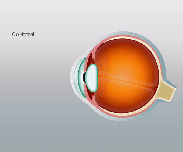 ¿Qué es el astigmatismo?