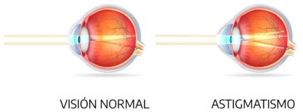 ¿Cómo saber si tengo astigmatismo?