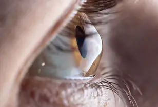 Lentillas para queratocono: tipos, adaptación y resultados esperados Lentillas para queratocono