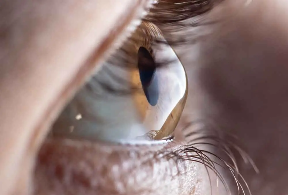 Lentillas para queratocono