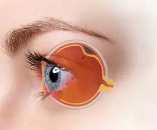 Razones que provocan el desprendimiento de retina Razones que provocan el desprendimiento de retina