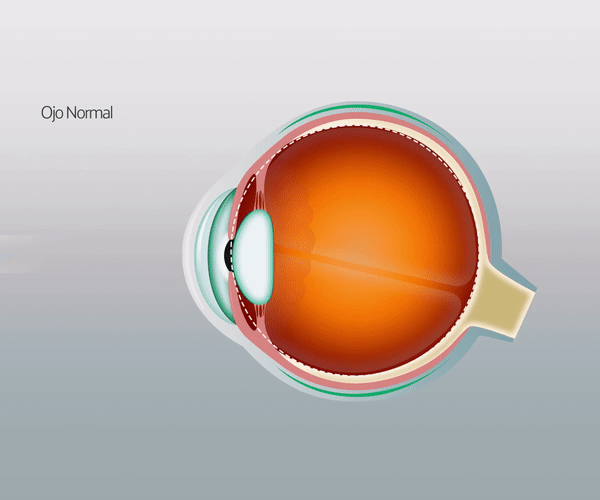 Defectos refractivos más comunes es la miopía.