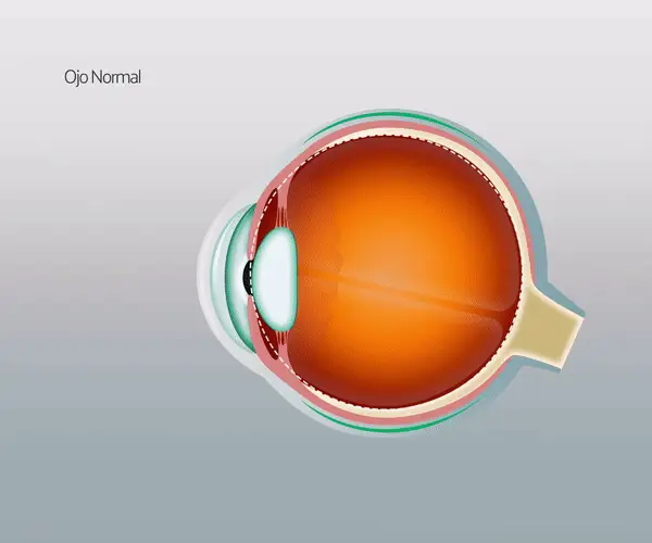 ¿Qué es la hipermetropía?