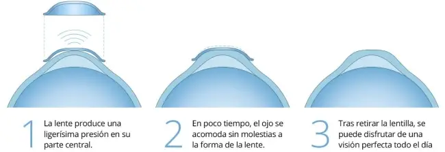 Orto K: Lentillas Correctoras