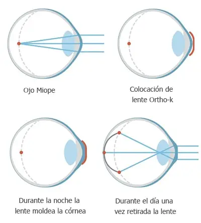 Ortoqueratología: ¿Cómo funciona?