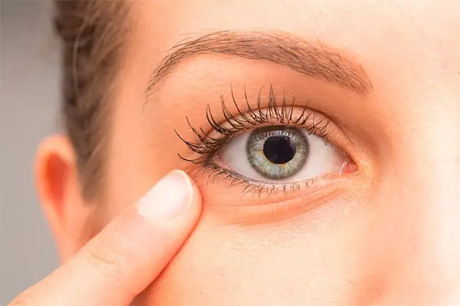 Qué es la Midriasis