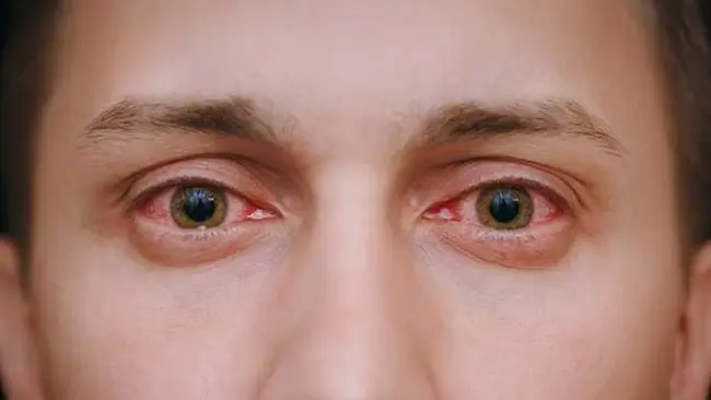 Ojos Rojos: causas y tratamientos
