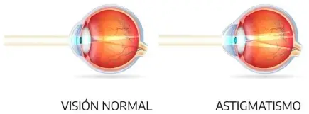 ¿Cómo saber si tengo astigmatismo? ¿Cómo saber si tengo astigmatismo?