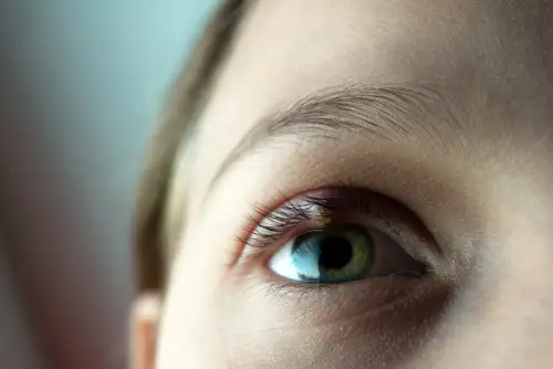 Orzuelo en el ojo Orzuelo en el ojo