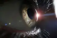 Degeneración macular en los ojos
