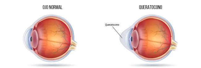 Qué es el queratocono