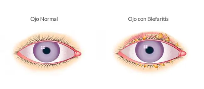 ¿Qué es la blefaritis? ¿Qué es la blefaritis?