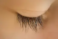 Triquiasis palpebral