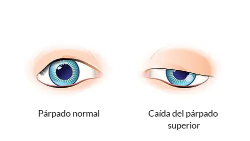 Ptosis palpebral