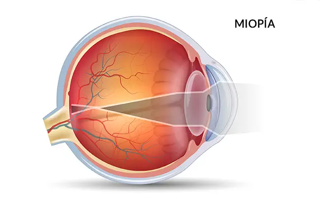 ¿Existe una Cura Definitiva para la Miopía?