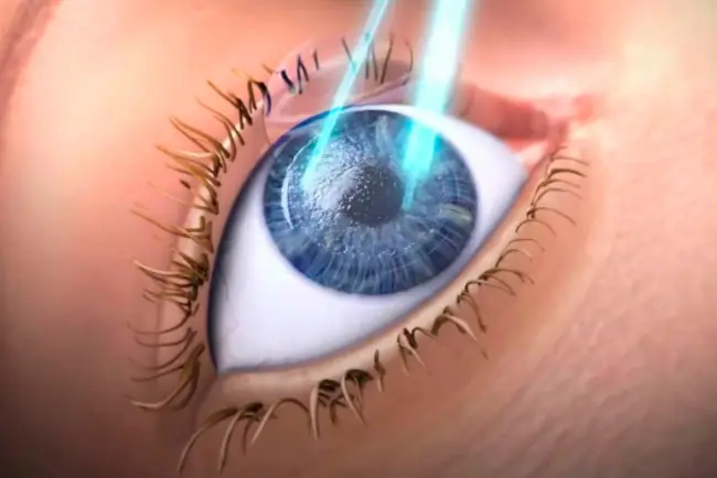 LASIK (queratomileusis in situ con láser) LASIK (queratomileusis in situ con láser)
