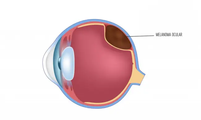 Melanoma Ocular - Un Tipo de Cáncer que Afecta a la Visión Melanoma Ocular - Un Tipo de Cáncer que Afecta a la Visión