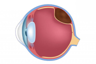 Melanoma Ocular: qué es, síntomas y tratamientos