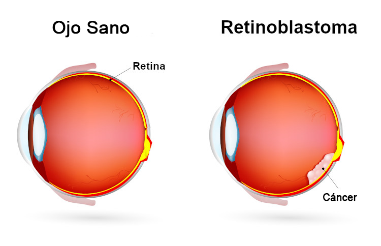 Síntomas del retinoblastoma