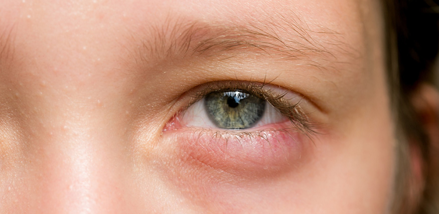 Infecciones Bacterianas de los Ojos