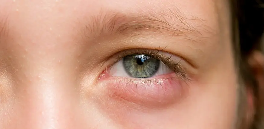 Infecciones Bacterianas de los Ojos Infecciones Bacterianas de los Ojos