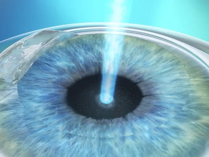 Cirugías láser LASIK, LASEK y PRK Cirugías láser LASIK, LASEK y PRK