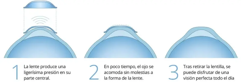 Orto K: Lentillas Correctoras