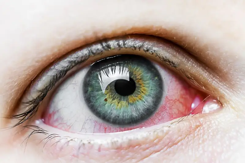 Hiperemia conjuntival Hiperemia conjuntival