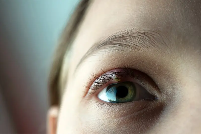Orzuelo en el ojo Orzuelo en el ojo