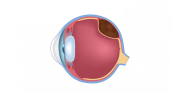 Melanoma Ocular: qué es, síntomas y tratamientos
