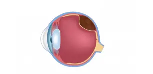 Melanoma Ocular: qué es, síntomas y tratamientos