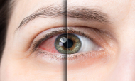 Infecciones Oculares Ocasionadas por Estreptococo