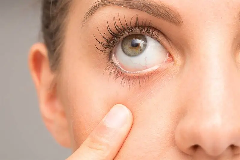 Que és y Causas Tic del Ojo Que és y Causas Tic del Ojo